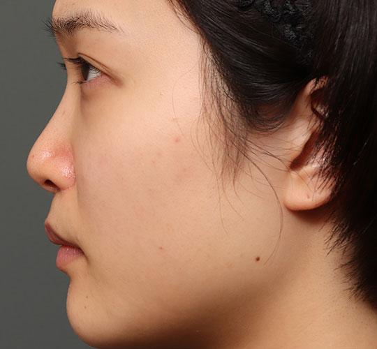 20代女性の人中短縮（リップリフト） After 症例写真