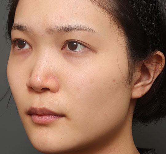 20代女性の人中短縮（リップリフト） Before 症例写真