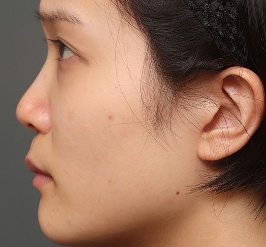 20代女性の人中短縮（リップリフト） Before 症例写真