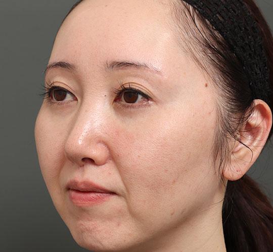 40代女性の人中短縮（リップリフト） After 症例写真