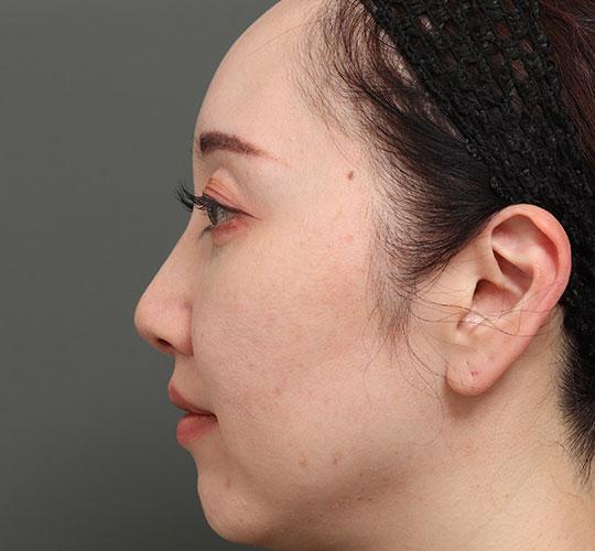 40代女性の人中短縮（リップリフト） After 症例写真