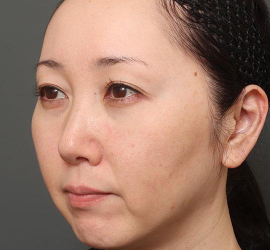 40代女性の人中短縮（リップリフト） Before 症例写真