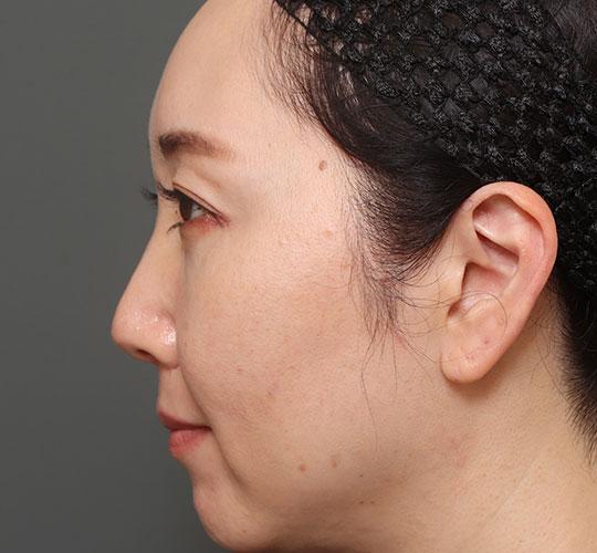 40代女性の人中短縮（リップリフト） Before 症例写真