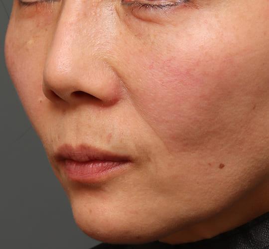 40代女性の人中短縮(リップリフト) Before 症例写真