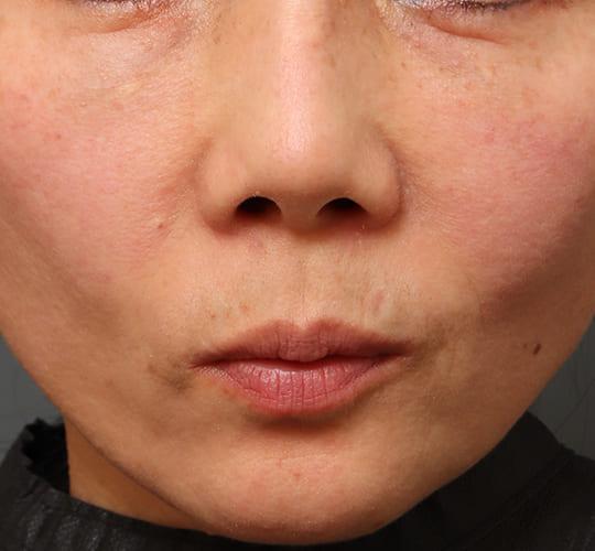 40代女性の人中短縮(リップリフト) Before 症例写真