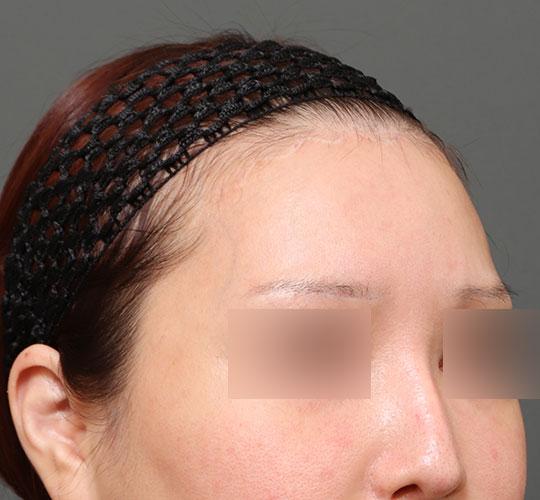 30代女性のエラ・アゴ・小顔 After 症例写真