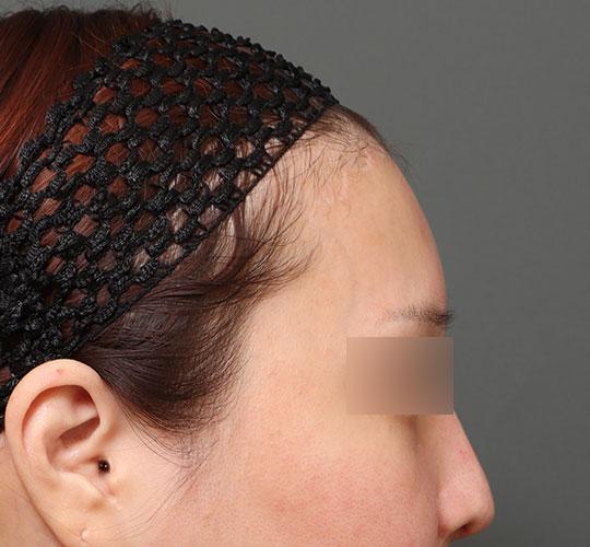 30代女性の額縮小 After 症例写真