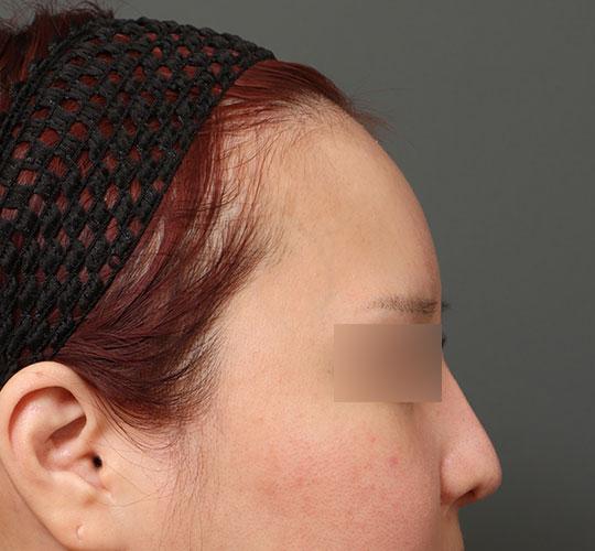 30代女性の額縮小 Before 症例写真