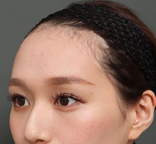 20代女性のエラ・アゴ・小顔 After 症例写真