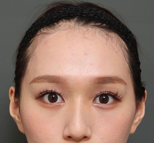20代女性の額縮小 After 症例写真