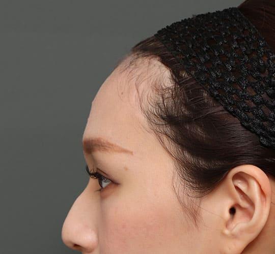 20代女性の額縮小 After 症例写真