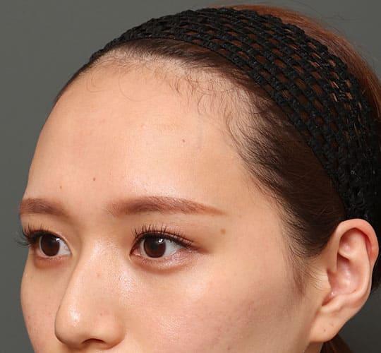 20代女性のエラ・アゴ・小顔 Before 症例写真