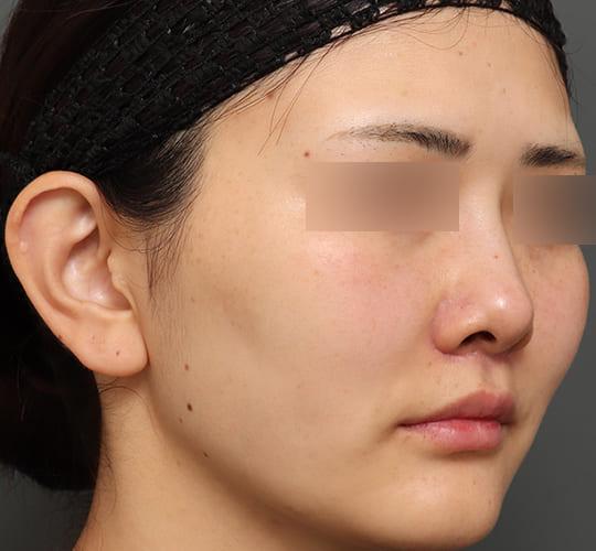 20代女性の人中短縮(リップリフト) After 症例写真