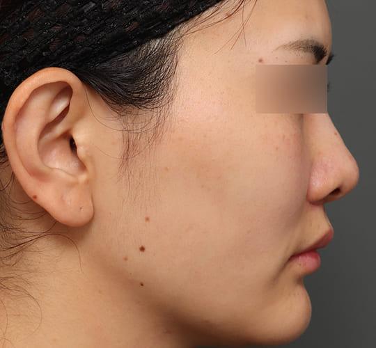 20代女性の人中短縮(リップリフト) After 症例写真