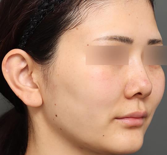 20代女性の人中短縮(リップリフト) Before 症例写真