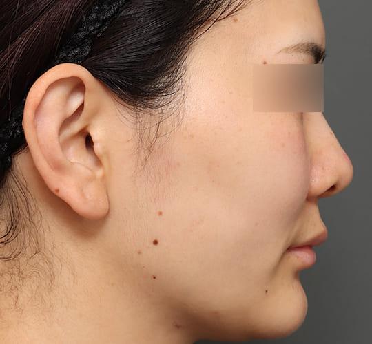 20代女性の人中短縮(リップリフト) Before 症例写真