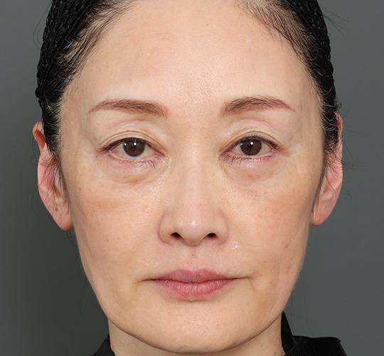 50代女性の再生医療（顔） After 症例写真