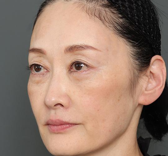 50代女性の真皮線維芽細胞療法 After 症例写真