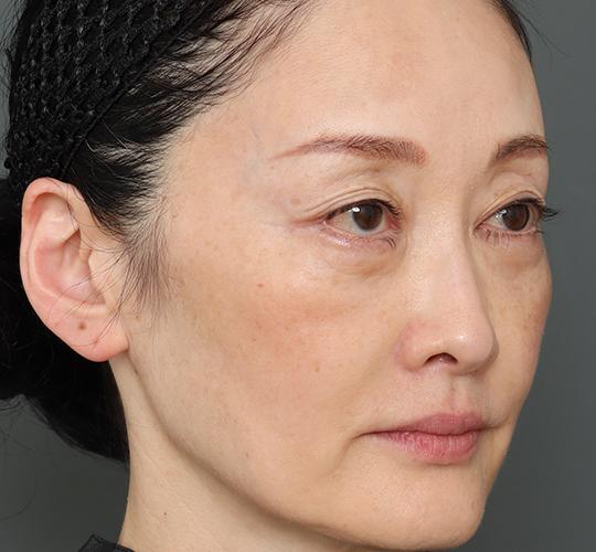 50代女性の真皮線維芽細胞療法 After 症例写真