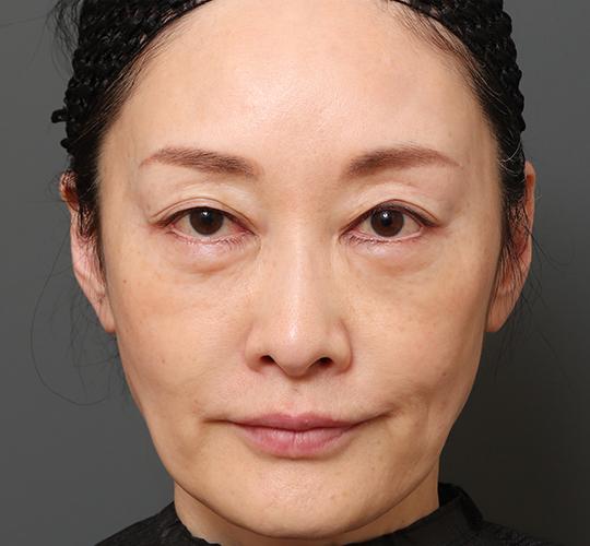 50代女性の再生医療（顔） Before 症例写真