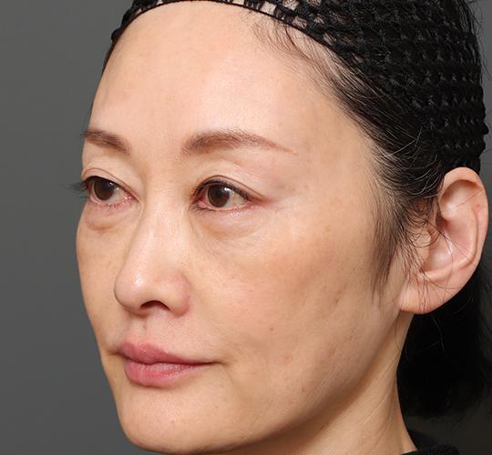 50代女性の真皮線維芽細胞療法 Before 症例写真