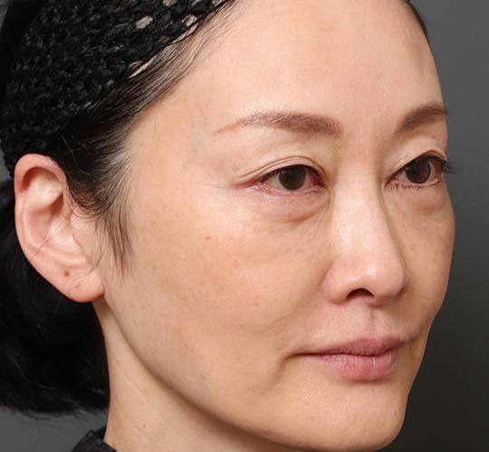 50代女性の真皮線維芽細胞療法 Before 症例写真