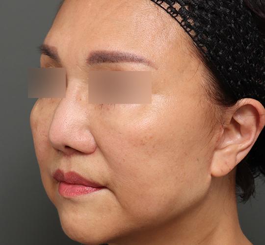 60代女性の人中短縮(リップリフト) After 症例写真