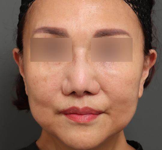 60代女性の人中短縮(リップリフト) After 症例写真