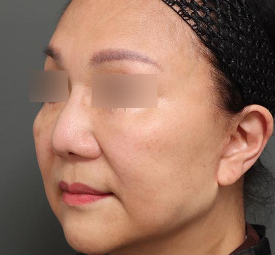 60代女性の人中短縮(リップリフト) Before 症例写真