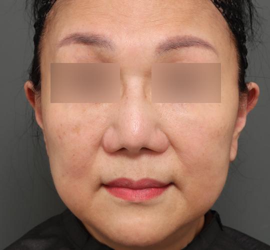 60代女性の人中短縮(リップリフト) Before 症例写真