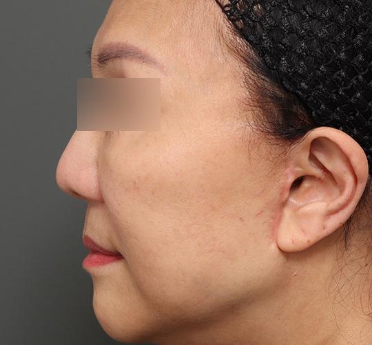 60代女性の人中短縮(リップリフト) Before 症例写真