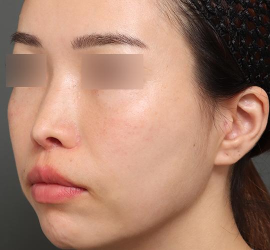 30代女性の人中短縮（リップリフト） After 症例写真