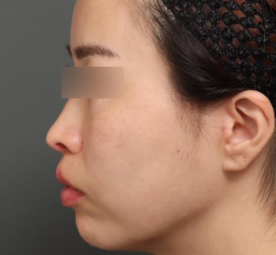 30代女性の人中短縮（リップリフト） After 症例写真