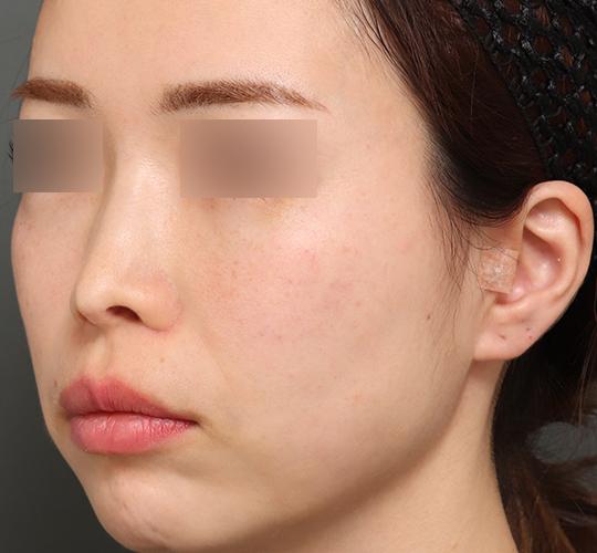 30代女性の人中短縮（リップリフト） Before 症例写真