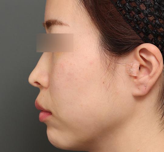 30代女性の人中短縮（リップリフト） Before 症例写真