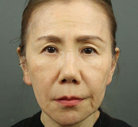 60代女性の輪郭オーダーメイド注入 After 症例写真