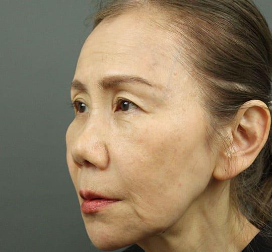 60代女性のヒアルロン酸注射 After 症例写真