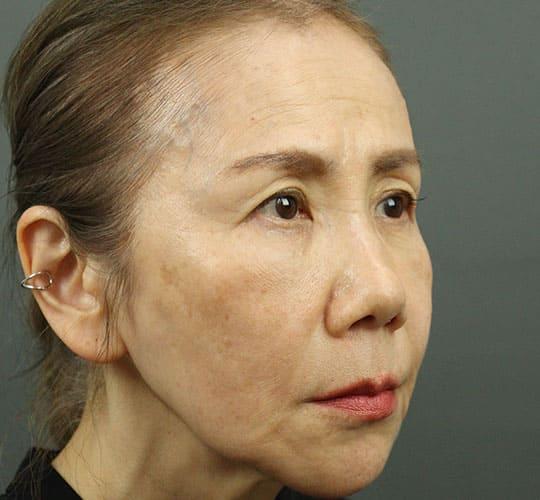 60代女性のヒアルロン酸注射 After 症例写真