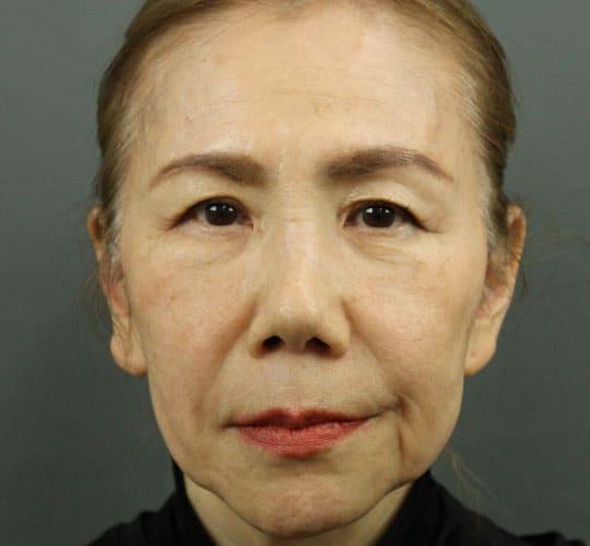 60代女性の輪郭オーダーメイド注入 Before 症例写真