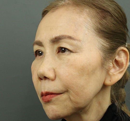 60代女性のヒアルロン酸注射 Before 症例写真