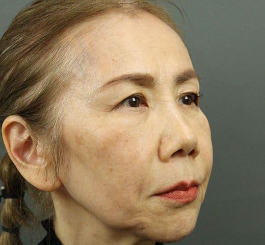 60代女性のヒアルロン酸注射 Before 症例写真