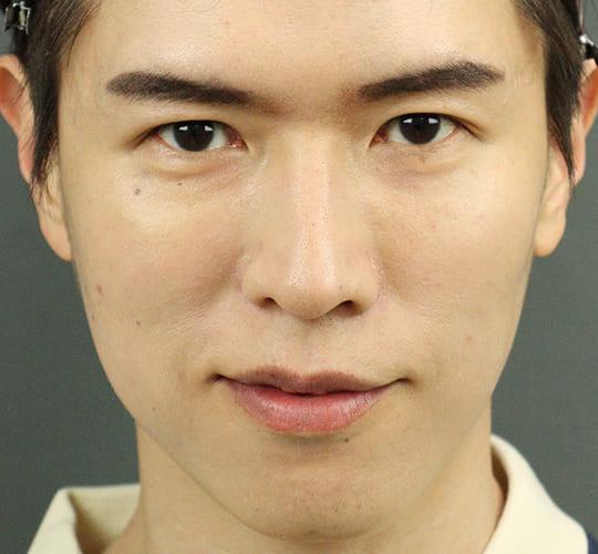 30代男性のヒアルロン酸注射 After 症例写真