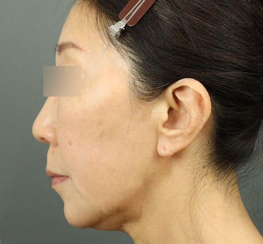 60代女性の輪郭オーダーメイド注入 After 症例写真