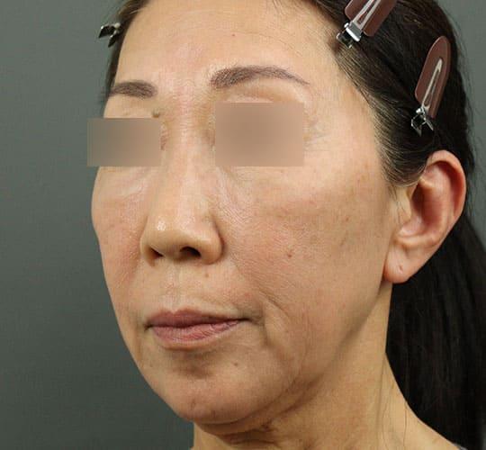 60代女性のヒアルロン酸骨格リフト Before 症例写真