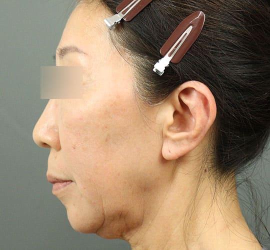 60代女性の輪郭オーダーメイド注入 Before 症例写真
