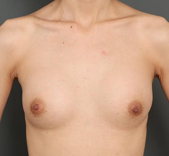 30代女性の豊胸バッグMotiva（モティバ） エルゴノミックス After 症例写真