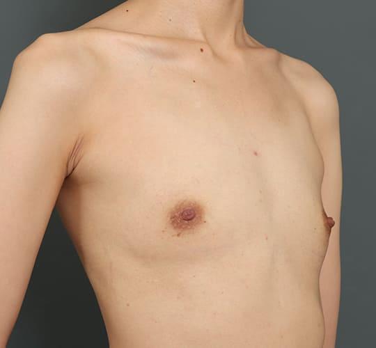 30代女性の豊胸バッグMotiva（モティバ） エルゴノミックス Before 症例写真