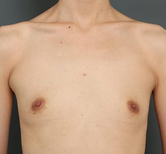 30代女性の豊胸バッグMotiva（モティバ） エルゴノミックス Before 症例写真