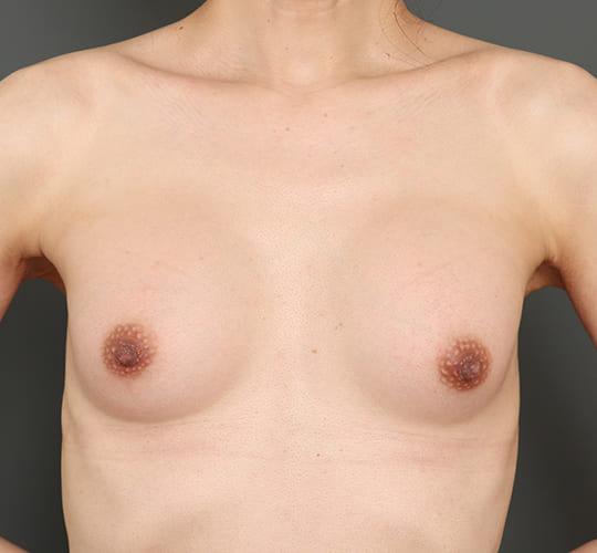 40代男性のMTF豊胸(トランスジェンダー豊胸) After 症例写真