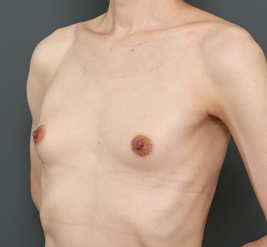 40代男性のMTF豊胸(トランスジェンダー豊胸) Before 症例写真